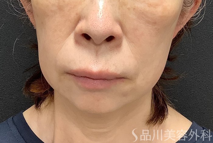 症例NO.75048のBEFORE写真