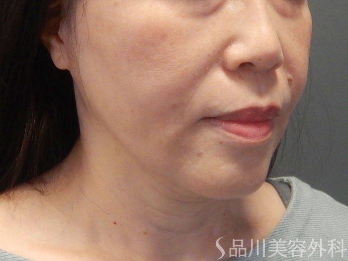 症例NO.70991のAFTER写真