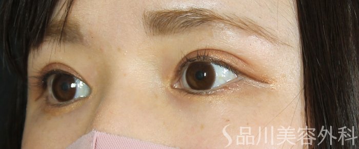 症例NO.69581のAFTER写真
