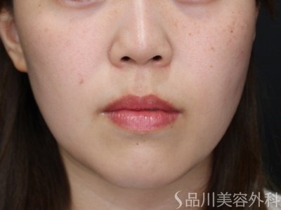 症例NO.72167のAFTER写真