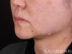 症例NO.72353のAFTER写真