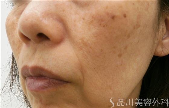 症例NO.20790のBEFORE写真