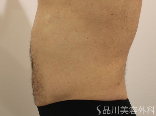 症例NO.74087のBEFORE写真