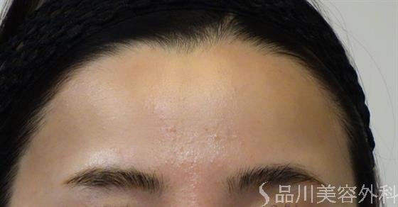 症例NO.47875のBEFORE写真
