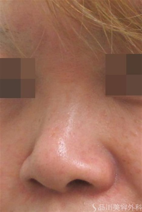 症例NO.23857のBEFORE写真