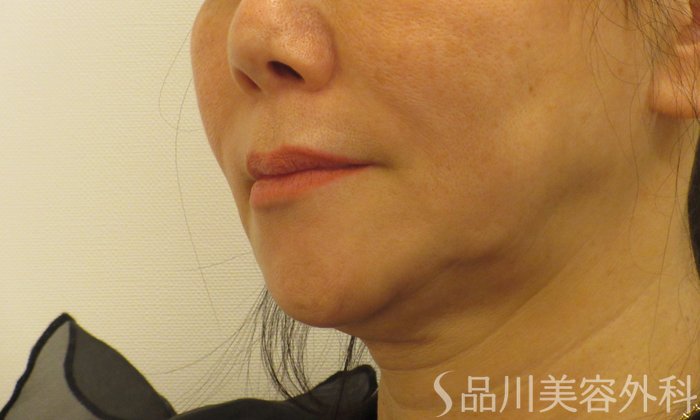 症例NO.73083のBEFORE写真