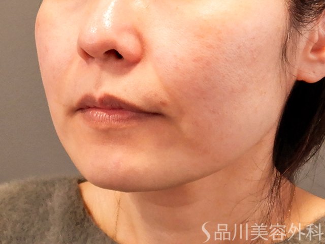 症例NO.69798のBEFORE写真