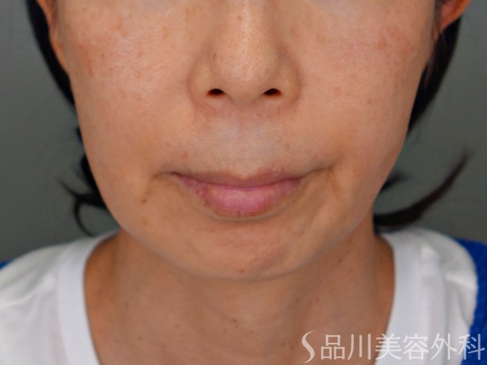 症例NO.69382のBEFORE写真