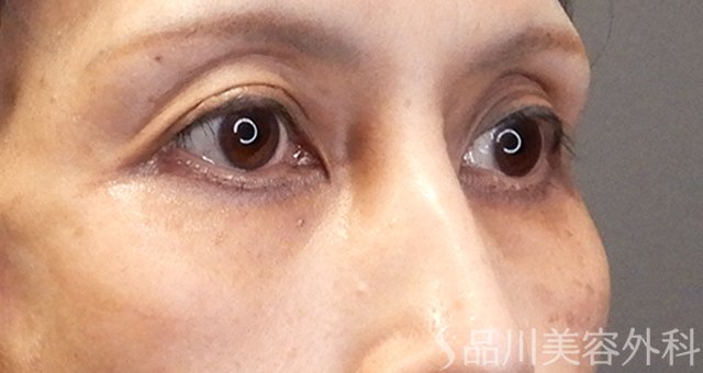 症例NO.67975のBEFORE写真