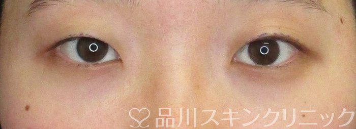 症例NO.74664のBEFORE写真