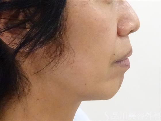 症例NO.39835のBEFORE写真