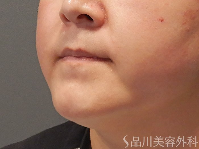 症例NO.68026のBEFORE写真