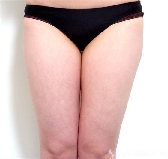 症例NO.27993のBEFORE写真