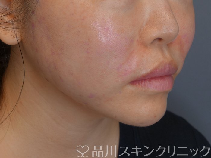 症例NO.71762のAFTER写真