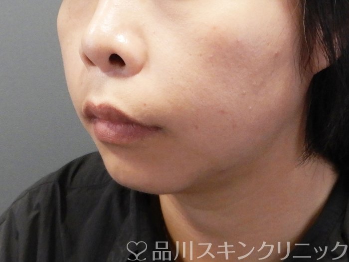 症例NO.72381のBEFORE写真