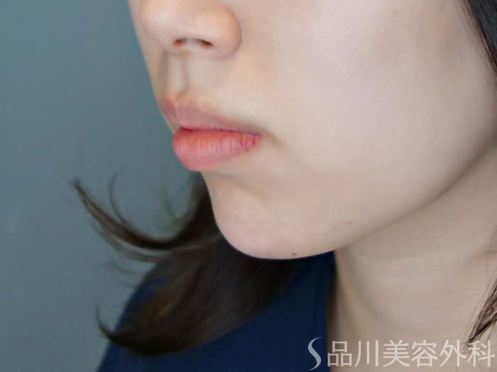 症例NO.70090のAFTER写真