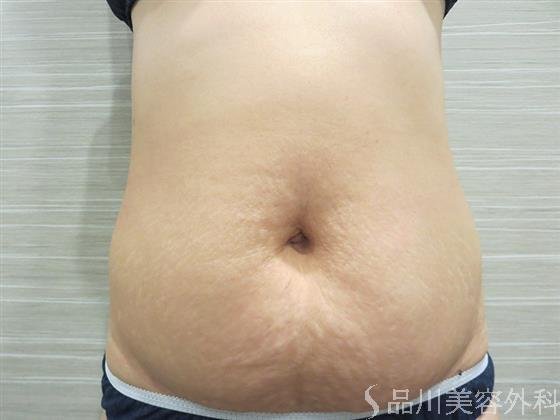 症例NO.20811のBEFORE写真