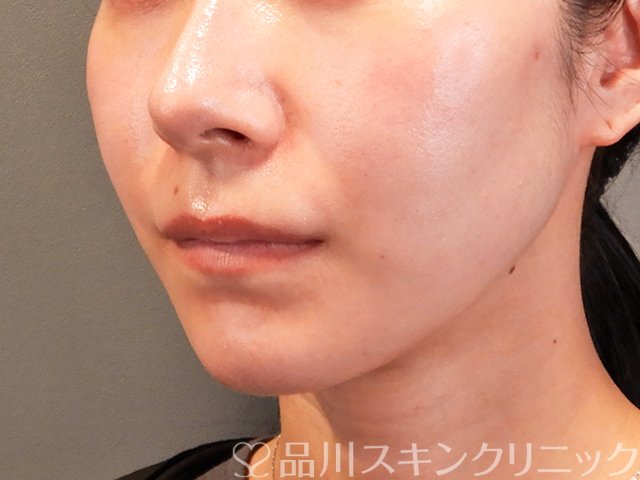 症例NO.70322のBEFORE写真