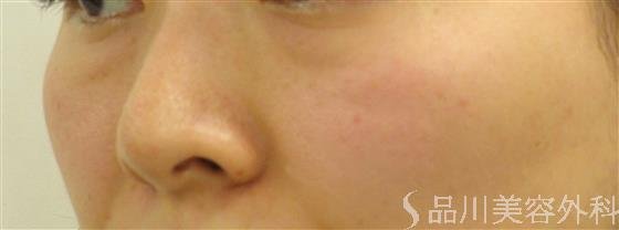 症例NO.59134のBEFORE写真