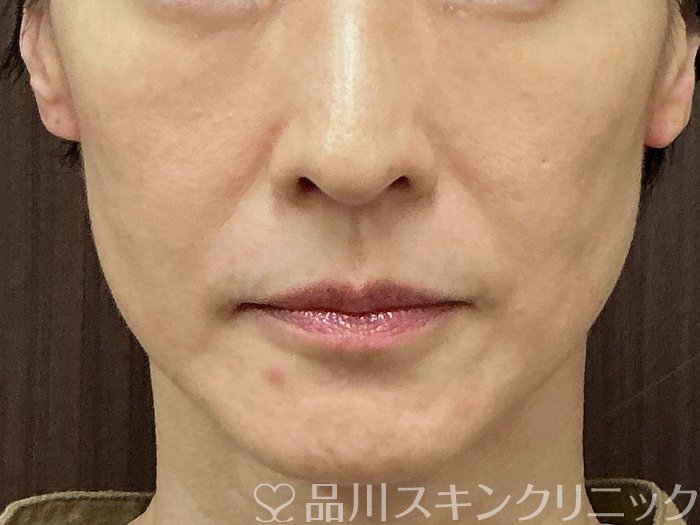 症例NO.74597のBEFORE写真