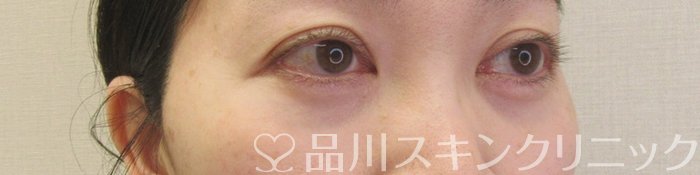 症例NO.69585のAFTER写真