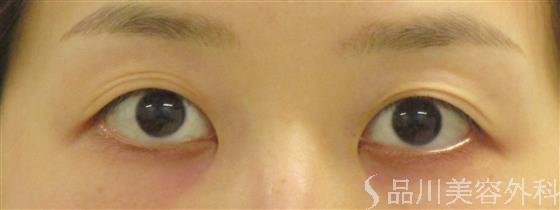 症例NO.55816のBEFORE写真