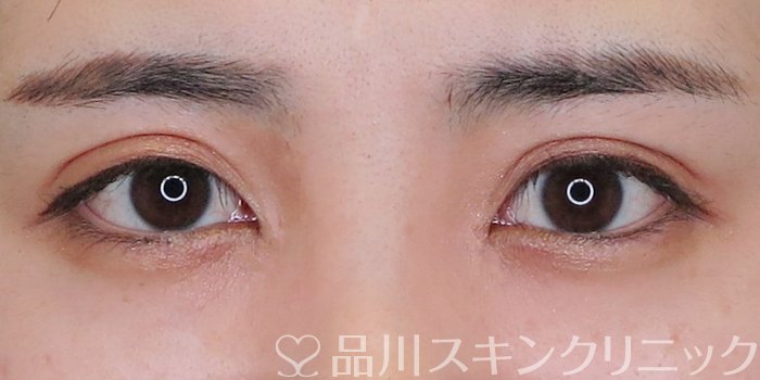 症例NO.69426のAFTER写真