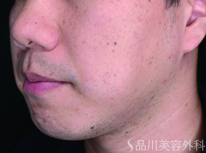 症例NO.70257のBEFORE写真