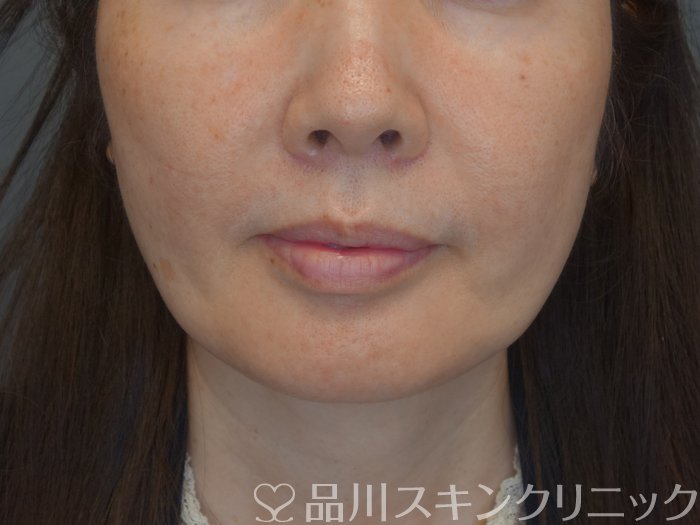症例NO.74216のBEFORE写真