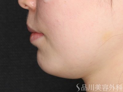 症例NO.72807のBEFORE写真