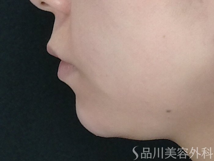 症例NO.70616のAFTER写真