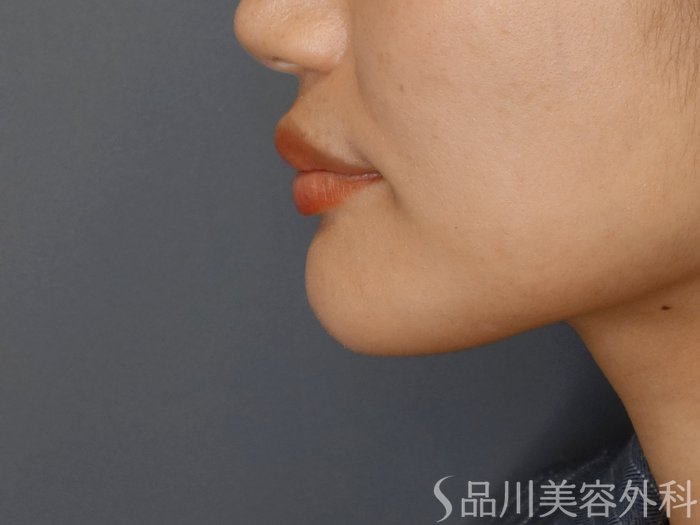 症例NO.71489のBEFORE写真