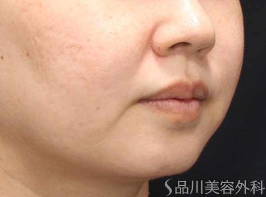 症例NO.75180のBEFORE写真