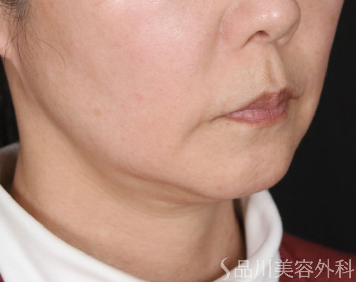 症例NO.72173のBEFORE写真