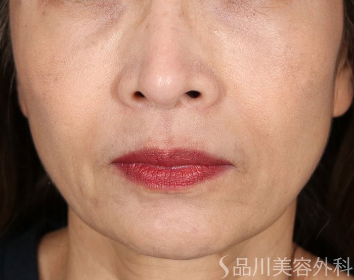 症例NO.71364のAFTER写真