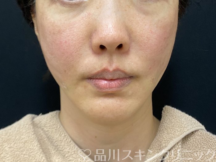 症例NO.73945のAFTER写真