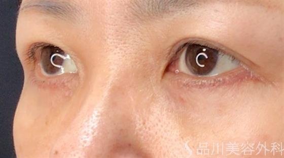 症例NO.59176のAFTER写真