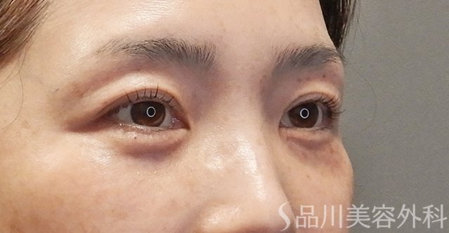 症例NO.74745のAFTER写真