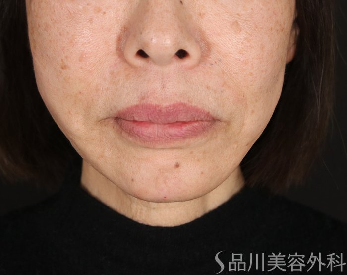 症例NO.72897のAFTER写真