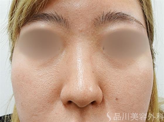 症例NO.33581のBEFORE写真