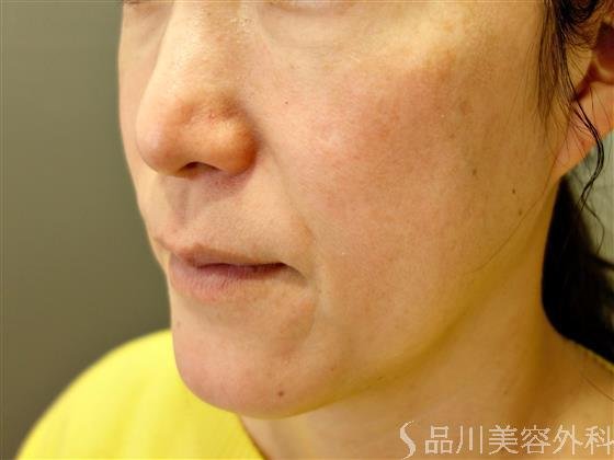 症例NO.50138のBEFORE写真