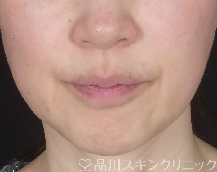 症例NO.68274のBEFORE写真