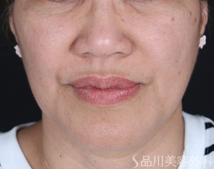 症例NO.73598のBEFORE写真