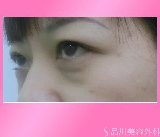 症例NO.13173のBEFORE写真