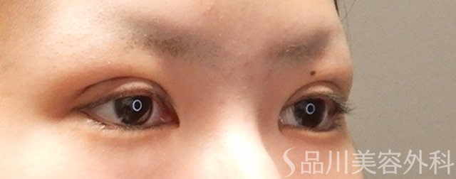 症例NO.72030のAFTER写真