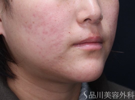 症例NO.73012のAFTER写真