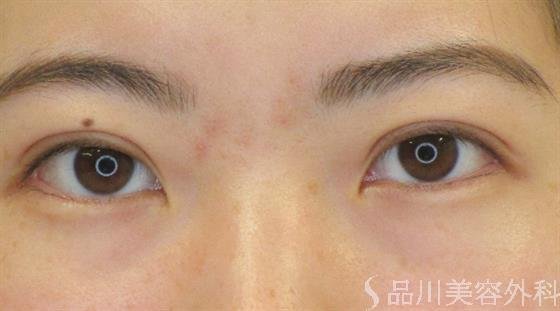 症例NO.47753のAFTER写真