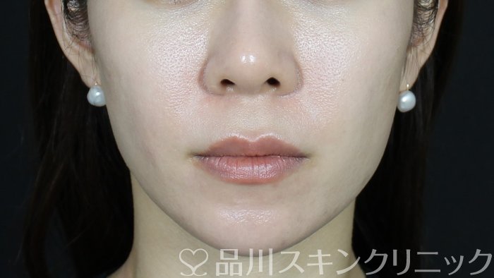 症例NO.71676のAFTER写真