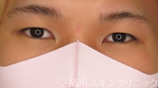 症例NO.71650のBEFORE写真