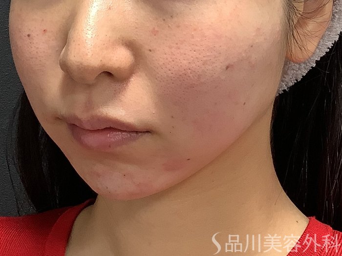 症例NO.75306のAFTER写真